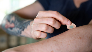 Fájdalom nélkül készíthető tartós tetoválás a tudósok egy új találmányával