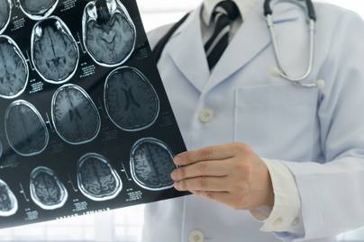 8 rizikófaktor, ami növeli a stroke kockázatát: ez a szűrővizsgálat életet menthet