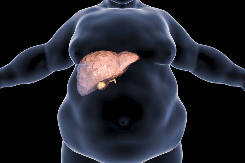 Már 1 kiló fogyás is sokat számít a zsírmáj kialakulása ellen: átfogó kutatást tettek közzé