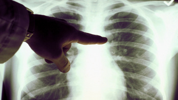 A tüdőrákban elhunytak 14 százaléka túl későn fordult orvoshoz