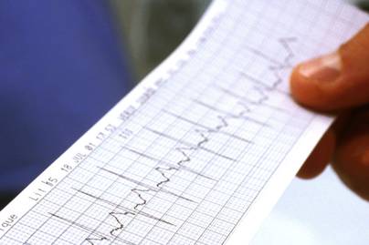 Ilyen egészségügyi problémákra utalhat az éjszakai erős szívdobogás - Milyen tüneteknél hasznos a 7 napos EKG?