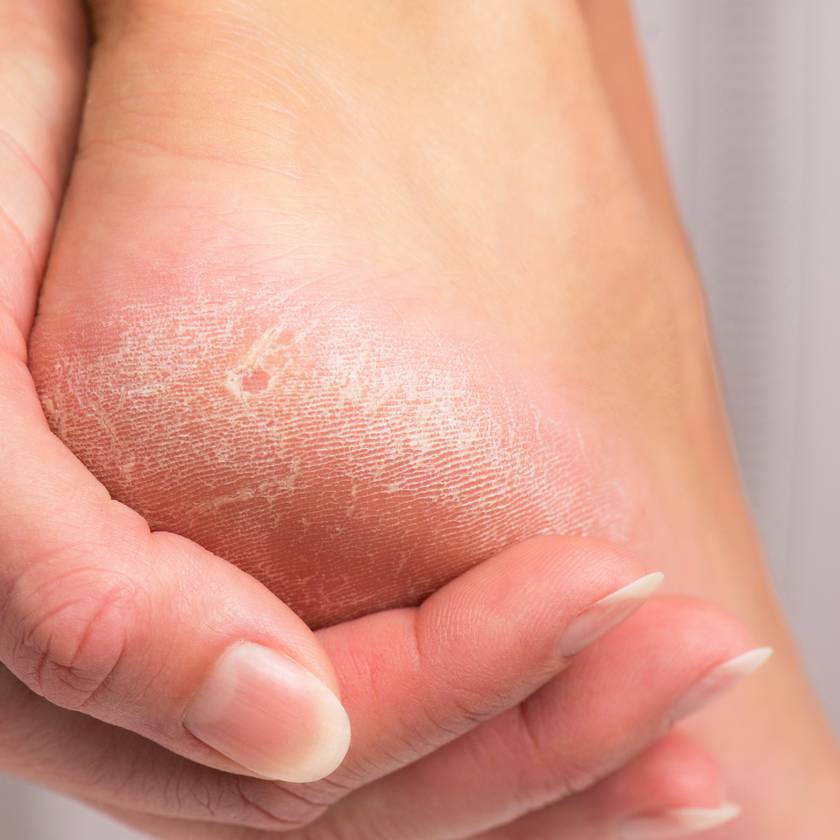Több betegség tünete lehet a megvastagodott bőr: nem csak a talpon jelentkezhet a hiperkeratosis