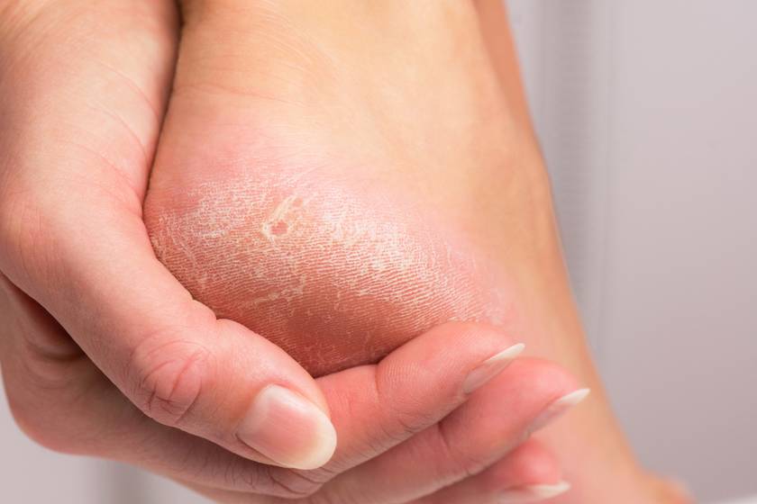 Több betegség tünete lehet a megvastagodott bőr: nem csak a talpon jelentkezhet a hiperkeratosis