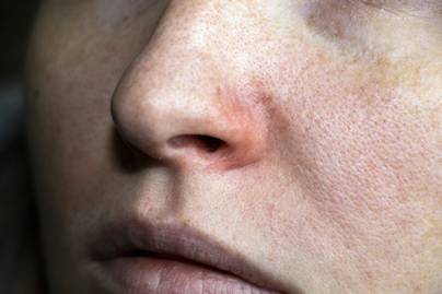 Amikor elsorvad az orr nyálkahártyája: így lehet felismerni az atrófiás náthát