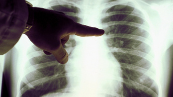 Átütő eredményeket értek el a tüdőrák kutatásában a magyar tudósok