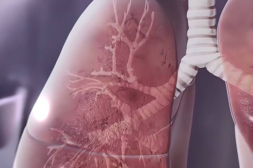 Miről ismerhető fel a tüdőfibrózis, kiket érinthet? A ritka betegséget nehéz észrevenni, pedig súlyosak a szövődményei