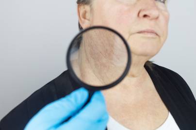 A zsírmáj 7 meglepő tünete a bőrön és a szemeken: sokan nem veszik komolyan az intő jeleit