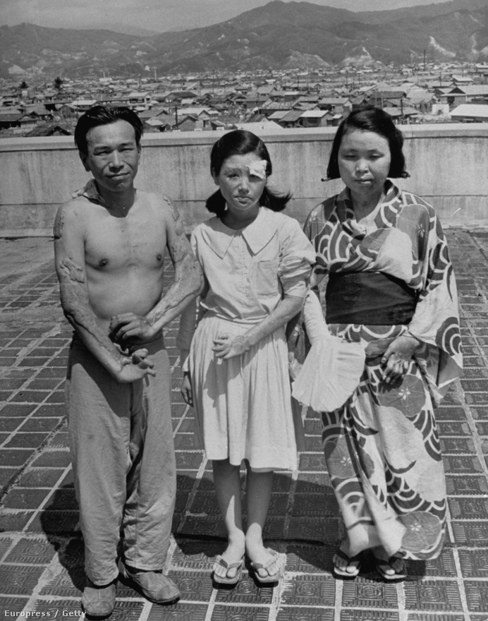 1945. augusztus 6-án dobta le az Enola Gay az atombombát Hirosimára, legalább 80 ezer civil áldozattal járt a művelet. A túlélőkről 1947-ben készült a kép, testük még mindig kelésekkel van tele. 