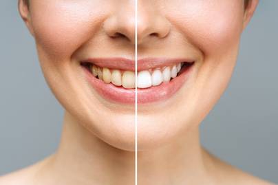 Fehérebbnek láttatják a fogakat, és ragyogóvá teszik a mosolyt - 8 fogkrém, amivel tényleg látványos a változás