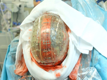 3D nyomtatott koponya mentett életet