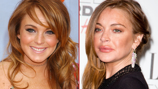 Van az úgy, hogy Lindsay Lohan túltolja a botoxot
