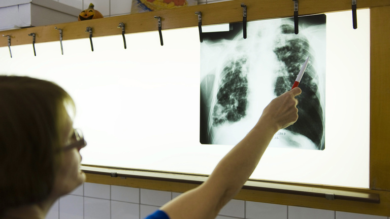 Hónapokig nem lesz tbc elleni oltás Magyarországon