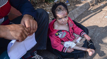 Budapesten ápolják az aleppói bombázásokban megsérült szír kisfiút