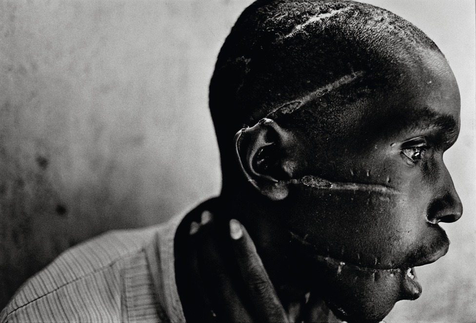 1995. Hutu nemzetiség ű fiatalember a Vöröskereszt nyanzai kórházában.&nbsp;Az Interahamwe hutu milícia szabdalta össze a férfi arcát, mert azzal gyanúsították őt, hogy szimpatizál a hutu lázadókkal. A ruandai hutu és tuszi népcsoport ellenségeskedése több évtizedes múltra tekinthet vissza. 1994 áprilisában Juvénal Habyarimana hutu nemzetiségű ruandai elnök tisztázatlan körülmények meghalt egy repülőgép-balesetben, ezt követően kezdődött a népirtás.James Nachtwey díjnyertes fotója egy megcsonkított arcú ruandai férfit ábrázol. A portré emlékezetes arcává vált annak a ruandai népirtásnak, a II. világháború utáni egyik legnagyobb népirtás. 1994-ben Ruandában a hutu szélsőségesek 100 ezer embert öltek meg minden héten, amit az ENSZ és a nagyhatalmak tétlenül néztek végig. A rádióból sugárzott gyilkos hisztériakampány eredményeként machetével mészároltak le teljes családokat, tömegével csonkítottak meg gyerekeket és gyújtották rá a templomokat a menedéket keresőkre.